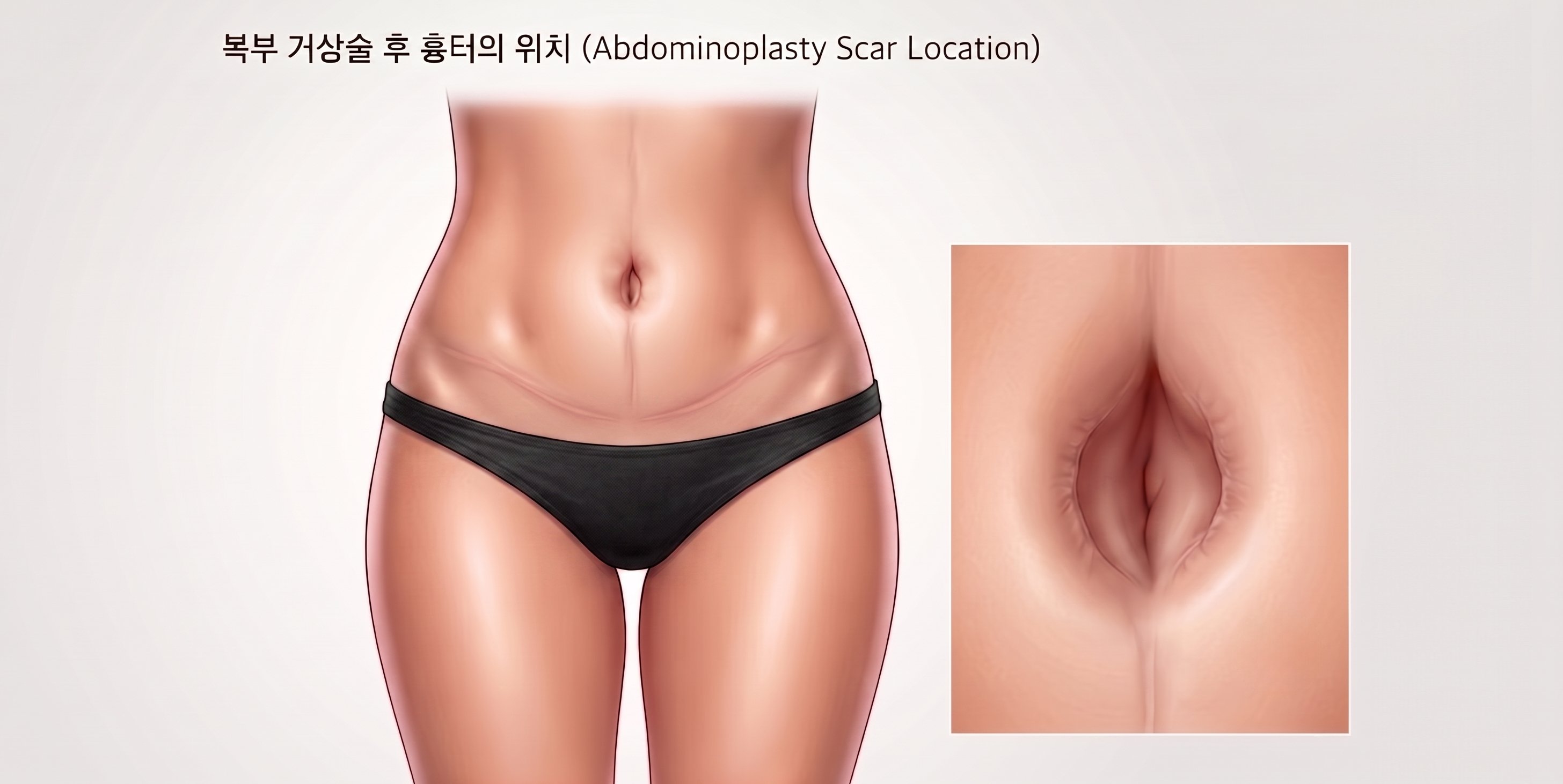 복부 invertedT거상 배꼽이동