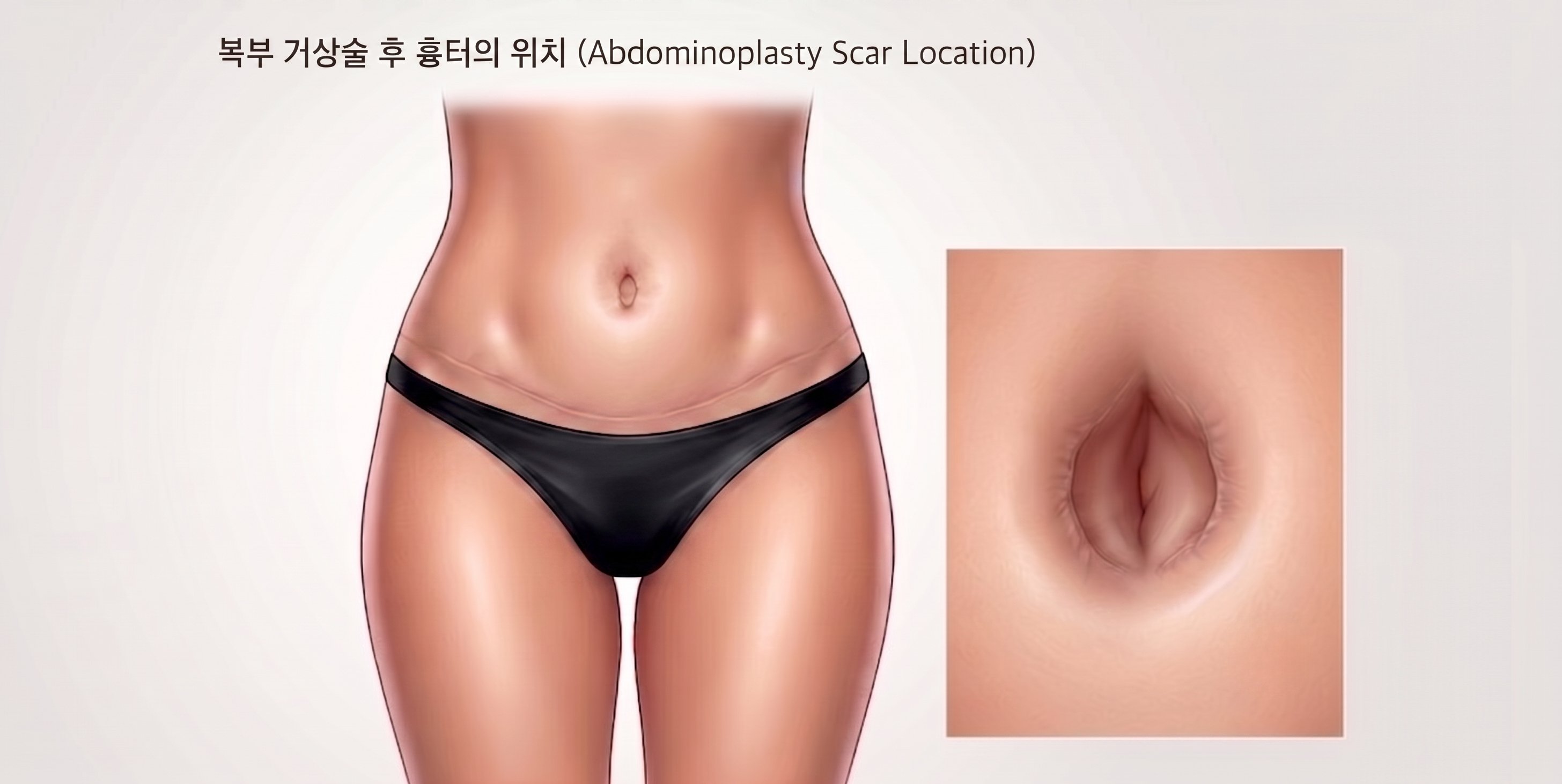 복부 배꼽이동