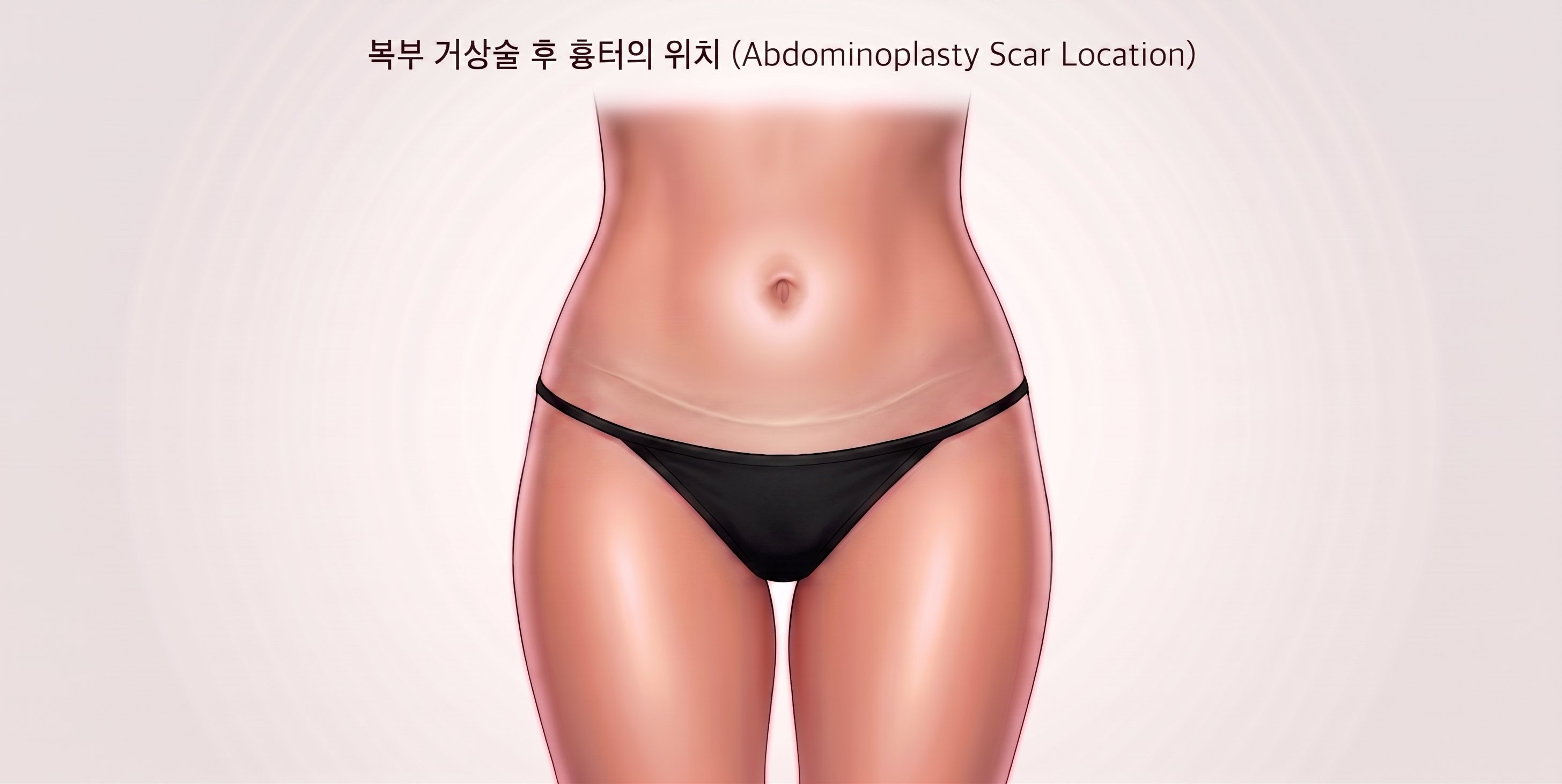 복부 미니거상